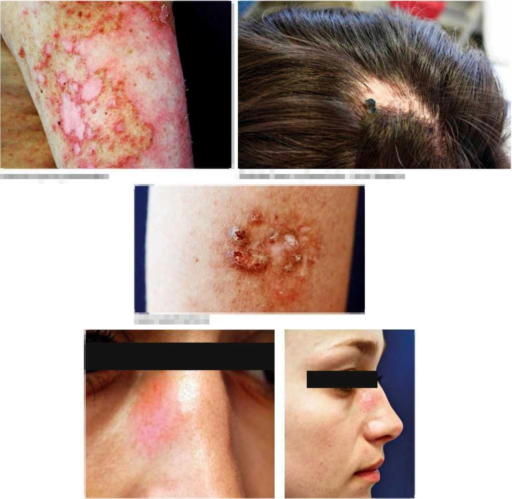 CELOŽIVOTNÍ VZDĚLÁVÁNÍ Diskoidní lupus erythematodes Diskoidní lupus erythematodes