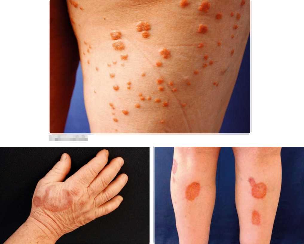 DERMATOLOGIE A OSTATNÍ OBORY Eruptivní xantomy Granuloma annulare