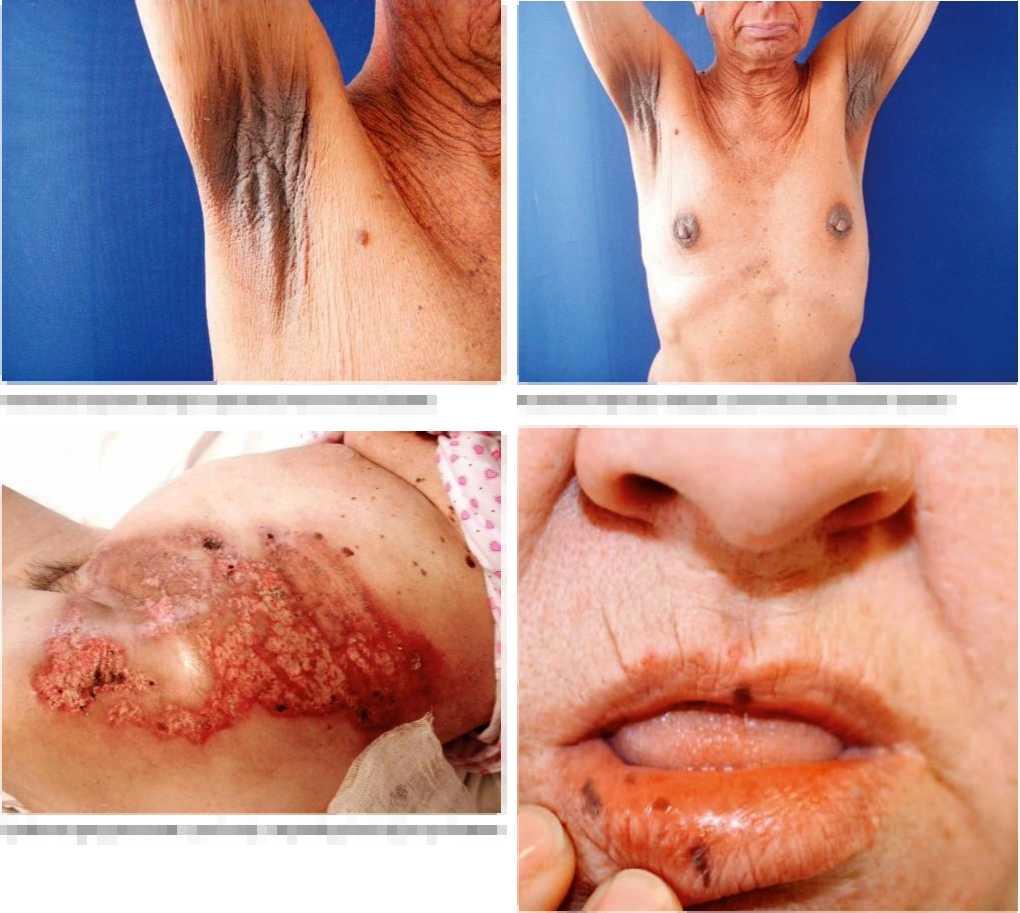 DERMATOLOGIE A OSTATNÍ OBORY Acanthosis nigricans maligna u pacienta s karcinomem žaludku Acanthosis nigricans maligna u pacienta s karcinomem žaludku Pyoderma gangraenosum u pacientky s