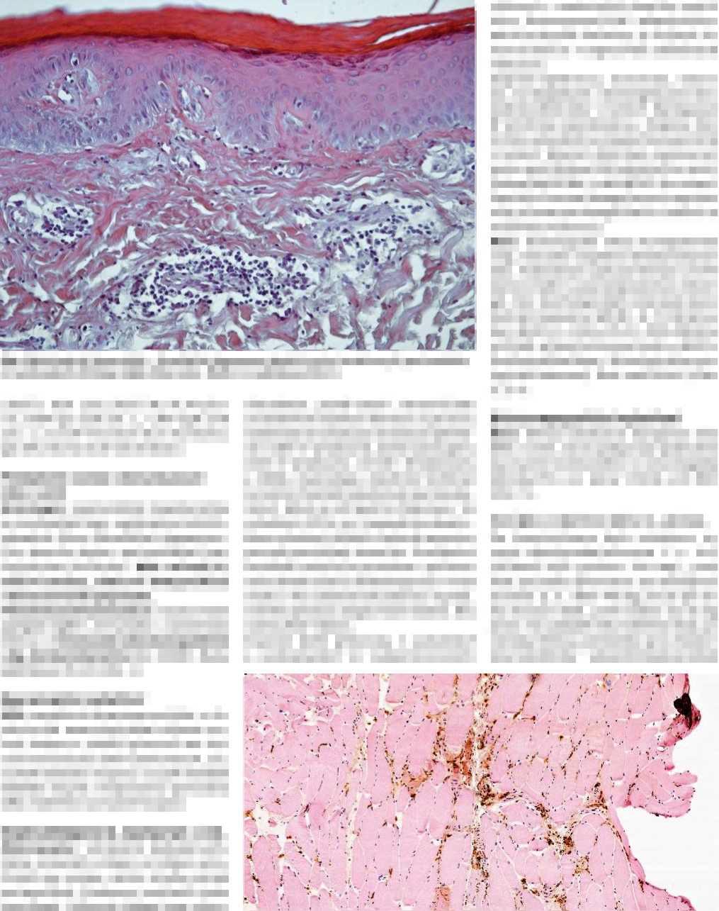 KAZUISTIKA Obr. 1 Histologický obraz kůže likvefakční degenerace bazální vrstvy keratinocytů, perivaskulární lymfocytární infiltráty (H&E 200x) (doc. MUDr