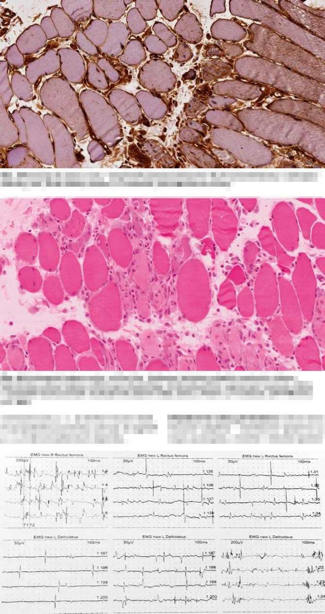 KAZUISTIKA Obr. 3 Histologický obraz svalu disperzně patrná overexprese HLA1 sarkolematicky i sarkoplazmaticky (IHC, HLA1 200x) (MUDr. E. Tvrdíková, ÚPA FN Brno a LF MU) Obr.