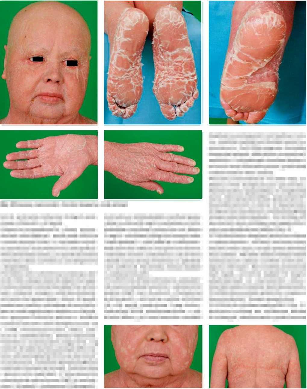 KAZUISTIKA Obr. 3 Progrese onemocnění, zhoršení alopecie, vznik ektropií bérců. Acitretin snížen na 30 mg/d, prednison střídavě 5 a 10 mg/d.