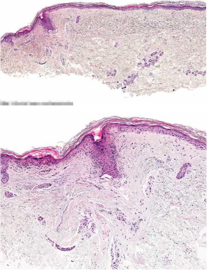 CELOŽIVOTNÍ VZDĚLÁVÁNÍ keratinocytů, endotelu cév a dendritických buněk produkujících interferony a jiné cytokiny, a následně k aktivaci CD4+ a CD8+ T-lymfocytů.