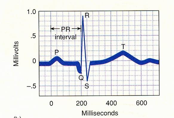 Elektrokardiografická křivka = elektrická aktivita srdce vlna P vzruch ze sinusového uzlu do síní