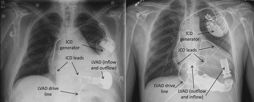 LVAD - Umístění Refaat M1, Chemaly E, Lebeche D, Gwathmey JK, Hajjar RJ.