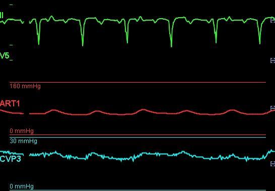 Fyziologické parametry LVAD pt Nepulsatilní průtok Obtížně hmatný puls Obtížná monitorace TK Obtížná monitorace SpO 2 Průtok až 10 l/min.