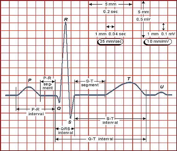 Obrázek 5 - Základní vlny a intervaly v EKG [6] 2.4 Poruchy srdečního rytmu Pokud dojde ke změně automacie tzv. pacemakeru (SA uzel), dochází ke generování vzruchů s vyšší nebo nižší frekvencí.