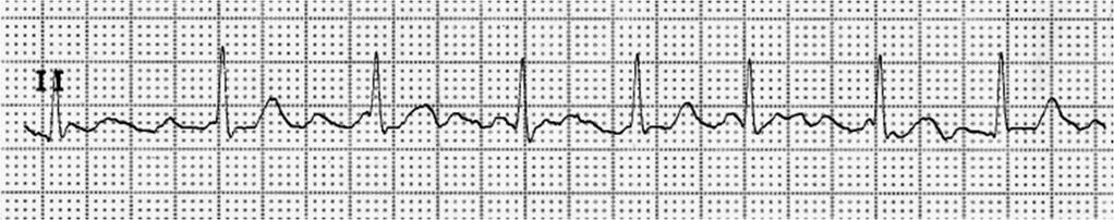 mechanické kontrakce síní Na EKG nejsou přítomny