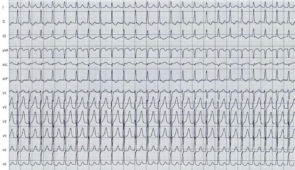 Supraventrikulární tachykardie Pravidelná tachykardie se štíhlými komplexy QRS o fr.