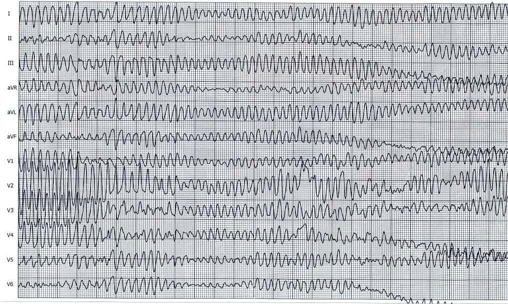 Fibrilace komor Disorganizovaná, chaotická elektrická aktivita komor. Hemodynamicky ekvivalent srdeční zástavy.