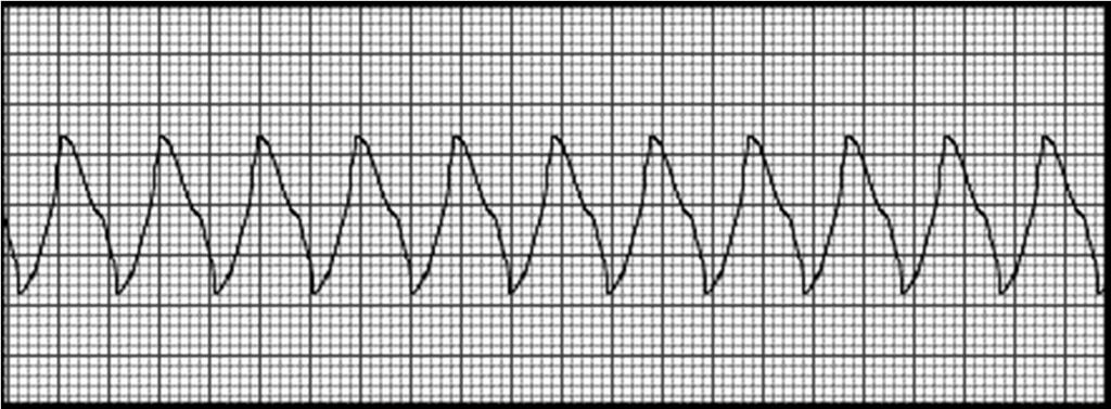 EKG diagnostika tachykardií 1. Jaká je šířka QRS komplexu?