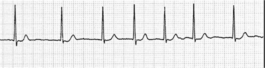 EKG diagnostika tachykardií 2. Je arytmie pravidelná?