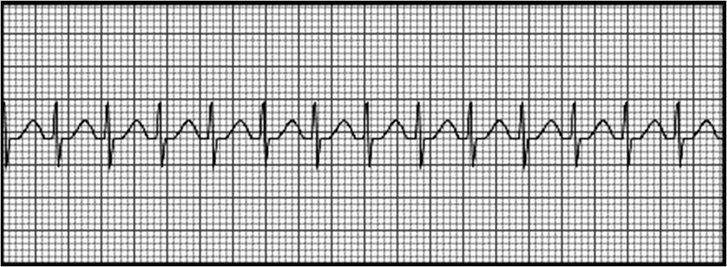 (zpravidla štíhlé komplexy QRS) Fibrilace síní Pravidelná