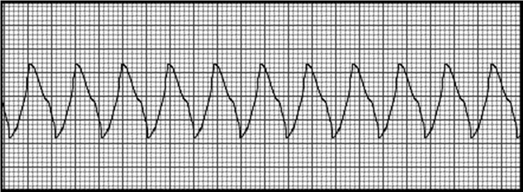 (široké stejně dlouhé) bizarní komplexy QRS) Supraventrikulární