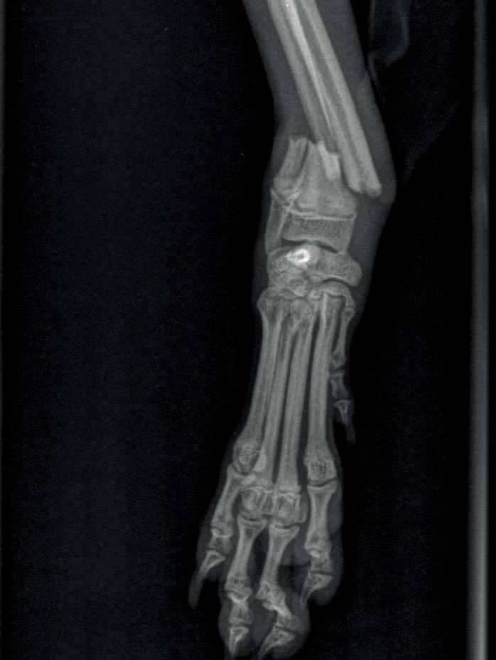 metodami externí a interní fixace, než byl případ referován. Jeden z těchto pacientů prodělal novou frakturu radiu v otvoru jednoho z naddimenzovaných šroubů (2,7 mm) a byl referován k reoperaci (obr.