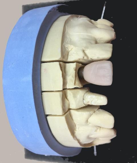 Modelace se provádí voskem do plně anatomického tvaru budoucí korunky (v případě dobarvovací techniky) viz. Obrázek 10, která se dále jen dobarvuje a na závěr glazuje.