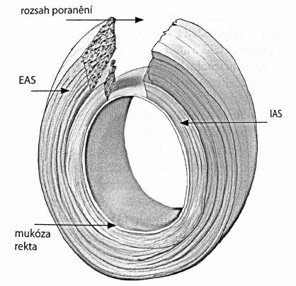Příloha V: Klasifikace ruptur perinea Ruptura perinea 3a dle RCOG. In: PAŘÍZEK, A. Kritické stavy v porodnictví. 1. vyd. Praha : Galén ; Kamenice : MCC Publishing, 2012. xxxii, 285 s.