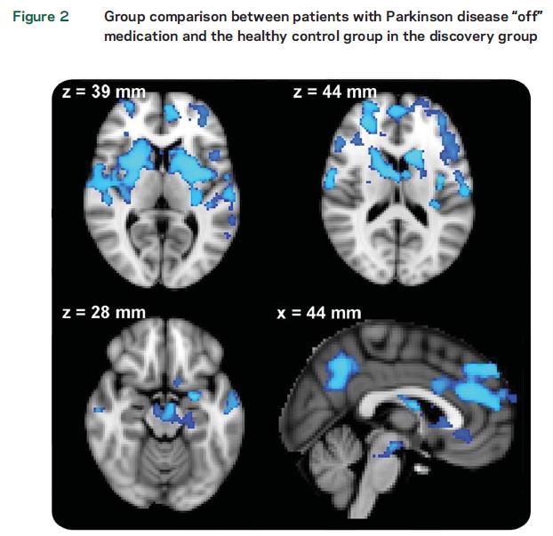 PN: síť bazálních ganglií a vliv dopaminu PN