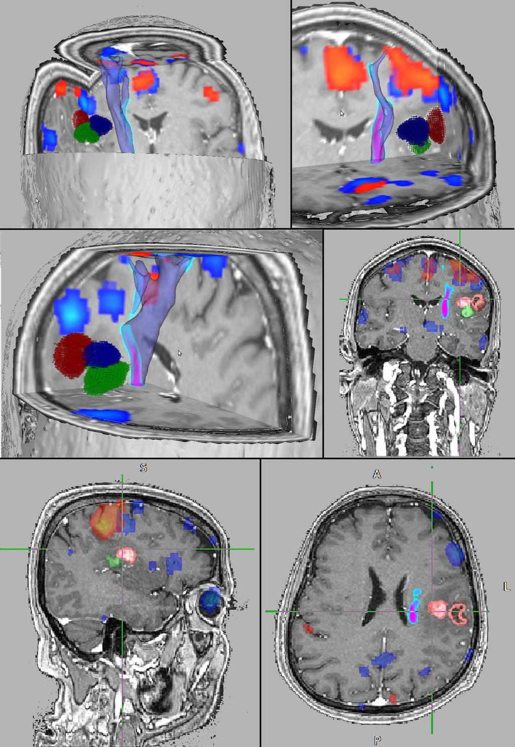 Obrázek 4.51: Pacient č. 7: traktografie pyramidové dráhy (modrofialově), fmri PHK (červeno-žlutá, p<0,001 FWE corrected), fmri VF (odstíny modré, p<0,001 bez korekce).