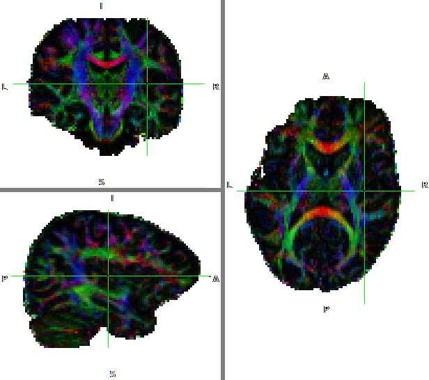 Obrázek 1.6: Barevné zobrazení převažujícího směru difuze červeně voxely, v nichž převažuje difuze zleva doprava (například corpus callosum), zeleně zepředu dozadu (např.