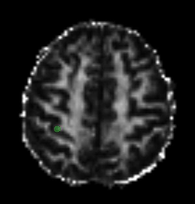 nezobrazeno) (b) Šedá hmota gyrus