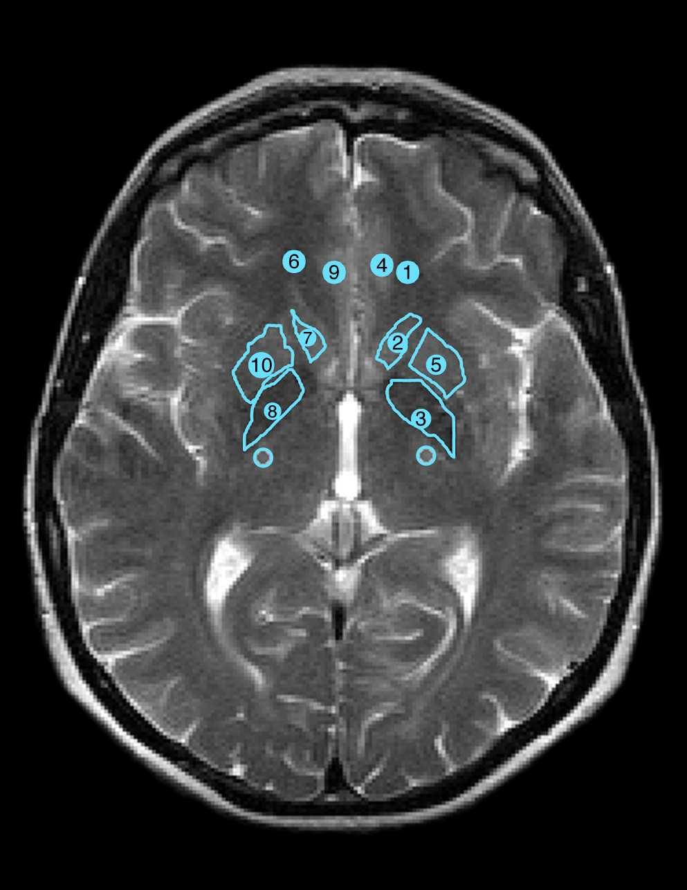 Obrázek 3.3: Oblasti zájmu - frontální bílá hmota (1,6), frontální šedá hmota (4,9), caput nuclei caudati (2,7), putamen (5,10), globus pallidus (3,8) a zadní raménko capsula interna (nečíslováno).