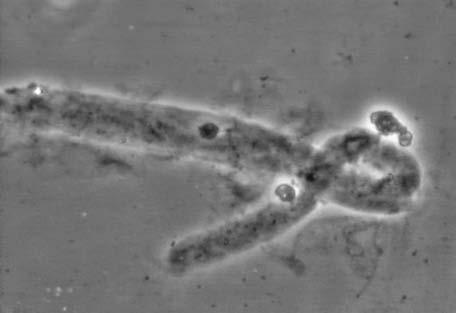 progredující glomerulonefritida (zejména pauciimmunní) membranoproliferativní glomerulonefritida I. a II.