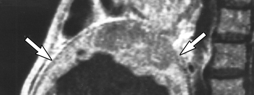 Příloha 1: Obrázek 12: MRI :Leiomyosarkom u 73-leté ženy-t1 vážené