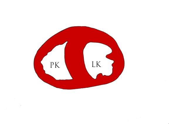 Změny pravé komory při PH. O3. Normální tvar PK. O4. Hypertrofie PK. O5.