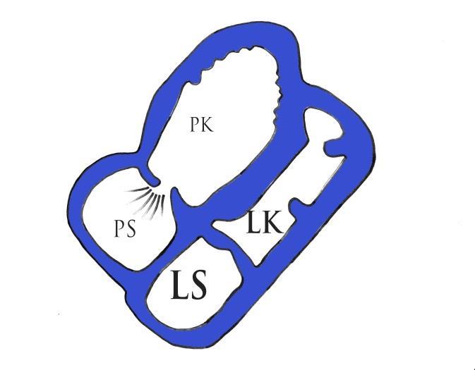 Zvětšená pravá komora a trikuspidální regurgitace. O6. Schéma zvětšené PK s trikuspidální regurgitací a útlakem levé komory. O7. Kontrastní CT. Zvětšení PS a PK s útlakem LK při IPAH. 1.