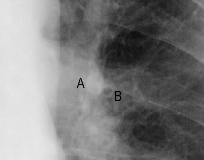Detail ortográdně zobrazené dilatované větve plicní tepny(a) ve srovnání s bronchem (B) stejného řádu.