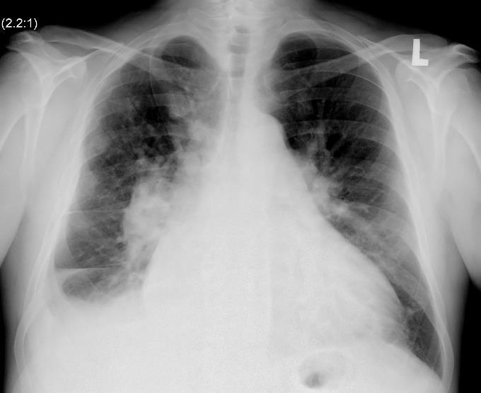 Oboustranné zvětšení plicních hilů na skiagramu hrudníku v PA projekci. O17.