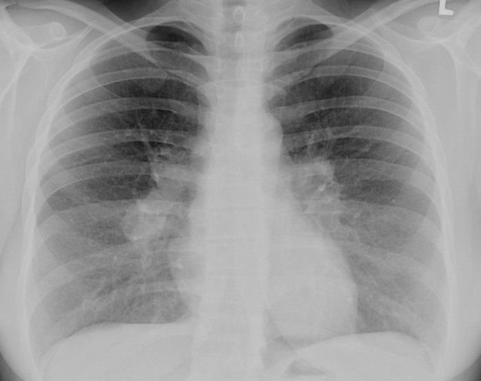 Výrazně prominující plicní hily na podkladě lymfadenopatie při sarkoidóze. Plicní tepny nejsou dilatovány a AB index není zvýšený (lze dobře hodnotit v levém hilu). 1.6.4 UZ hrudníku a břicha.