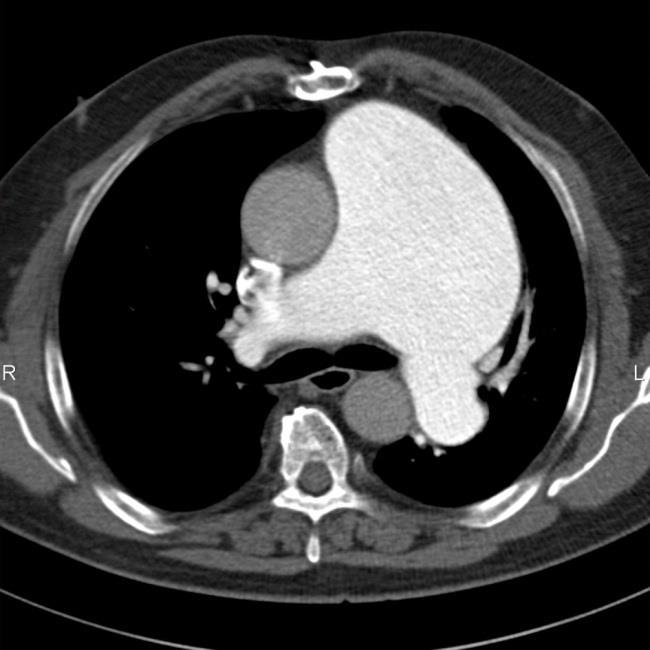 U dlouhotrvající těžké PH můžeme pozorovat nástěnné tromby a kalcifikace v centrálních plicních tepnách.