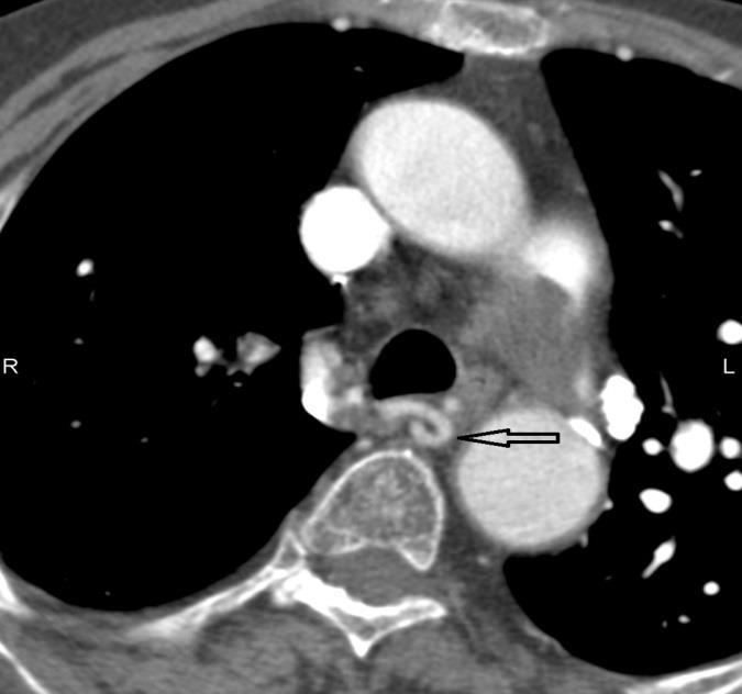 dochází v některých případech k hypertrofii bronchiálních tepen v mediastinu - vinuté cévy podél průběhu proximálních bronchů o šíři nad 1,5 mm.