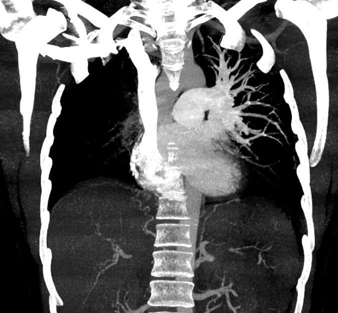 Reflux kontrastu do dilatované dolní duté žíly a jaterních žil při CT plicní angiografii představuje specifický příznak pro sekundární trikuspidální regurgitaci při PH.