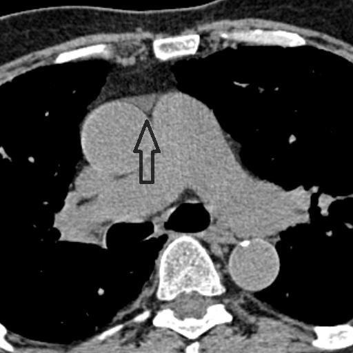 Nálezy na srdci na nativním CT hrudníku v mediastinálním okně. O32. Malé množství tekutiny v předním perikardiálním recesu (šipka)-bikini bottom sign. O33.