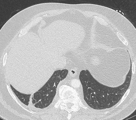 V případě výrazné dilatace plicnice a dalších jednoznačně vyjádřených CT nálezů bývá diagnóza PH plicní hypertenze velmi pravděpodobná, ačkoliv byly popsány i případy nemocných s kmenem plicnice o