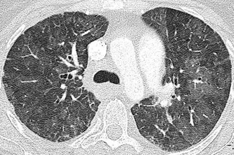 Snímky laskavě zapůjčeny od Praveena Rao, MCRC, MD z Radiology Department, Glenfield Hospital, University Hospitals of Leicester, Velká Británie 1.7.