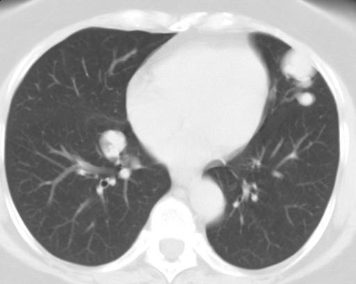 CT hrudníku u 50leté nemocné s hereditární hemoragickou telengiektiázií. O41.V plicním okně je patrná dvojice plicních uzlů v obou plicích s vinutými cévami v okolí. O42.