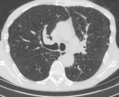 HRCT plic. Chronická plicní onemocnění obvykle vedoucí k PH. O43.Těžký centrilobulární emfyzém bez známek fibrózy. O44.
