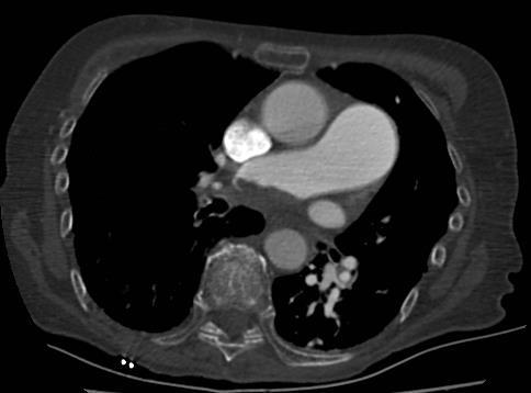 Defekty v náplni plicnice při PH zobrazené na CTPA. O45. 85letá žena s výraznou dilatací plicních tepen při CTEPH s nástěnným trombem v pravé plicní tepně. O46.