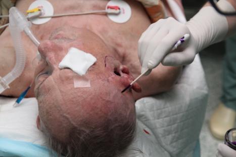 7.3. Materiály a metodika Foscan se podává intravenózně zavedenou kanylou do velké