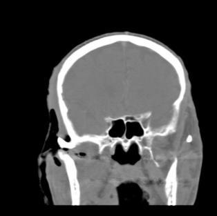 V léčbě byla využita i intraarteriální chemoterapie. Bohužel dosavadní veškerá terapie byla bez požadovaného léčebného efektu.