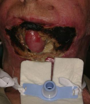 Onkologickým konziliem byla doporučena paliativní chemoterapie Methotrexate.