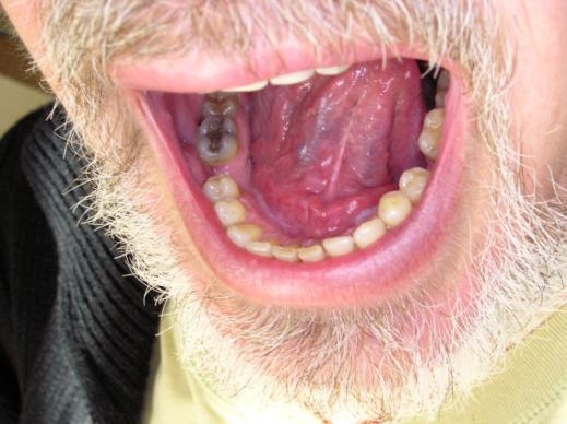 Léčebná terapie byla rozdělena do 2 návštěv. Při první návštěvě byla léčena distální část léze, následně byla léčena proximální část léze.