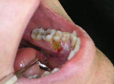 lokalizací orální leukoplakie na