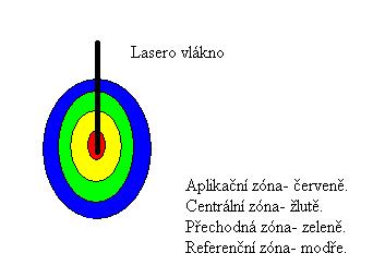 Cílem LITT je tepelně indukovaná akutní koagulační nekróza.