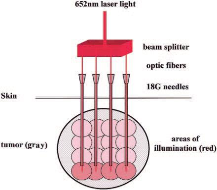 Laryngoskopy, Bronchoskopy [97, 122]. Obr. 5.9.: Primární laserový paprsek (652 nm) je rozdělen do 4 léčebných vláken, které umožňují dodání světla současně na čtyřech místech.