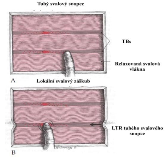 2.4.3 Lokální svalový záškub Lokální svalový záškub (LTR) je spinální reflex charakteristický mimovolní kontrakcí svalových vláken tuhého svalového snopce (75), který může být vyvolán přebrnknutím